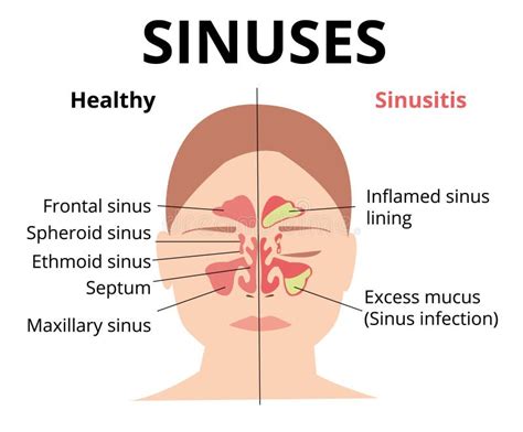 Sinusitis Medical Treatment Nasal Sinus Healthy And Inflammation