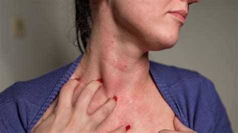 Skin Rash On Neck Thyroid