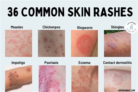 Skin Rashes On Stomach