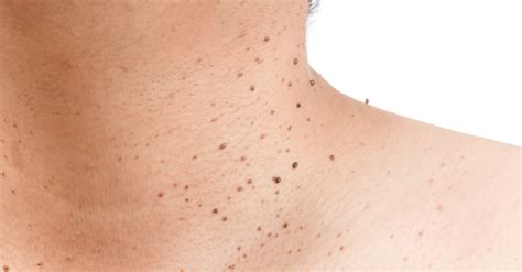 Skin Tags Images