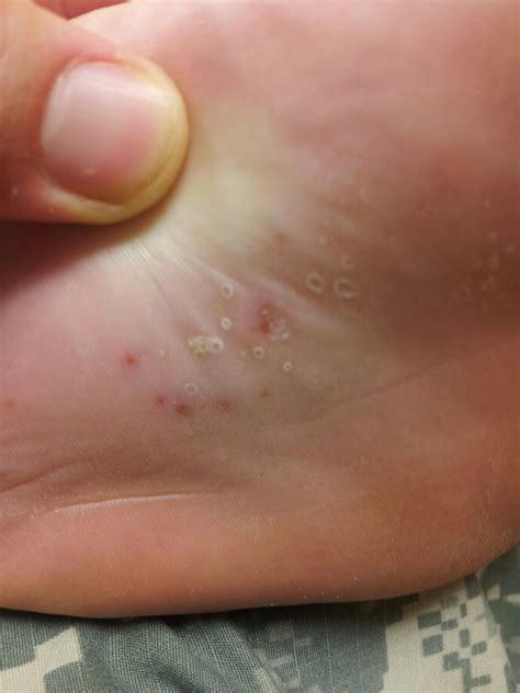 Small Blisters On Bottom Of Foot