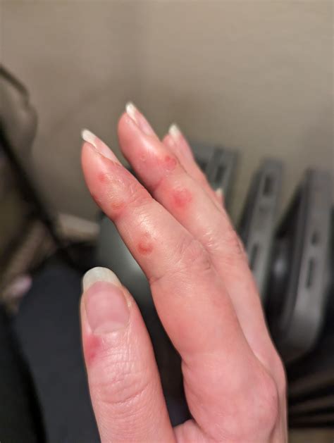 Sores On Fingers Not Itchy But Painful It S Been Weeks R Dermatology