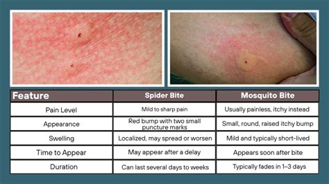 Spider Bite Vs Mosquito Bite