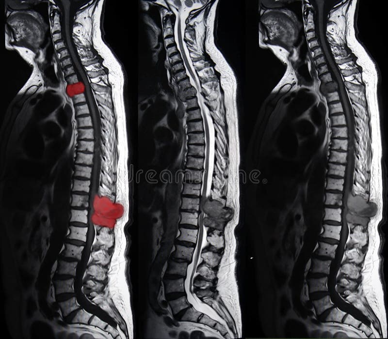 Spinal Metastatic Tumor Mri Stock Image Image 55788729
