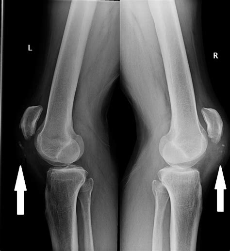 Spontaneous Simultaneous Bilateral Patellar Tendon Rupture Bmj Case
