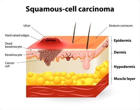 Squamous Cell Carcinoma Scc Symptoms Stages Risk Factors And