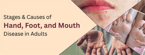 Stages Of Hand Foot And Mouth Disease In Adults