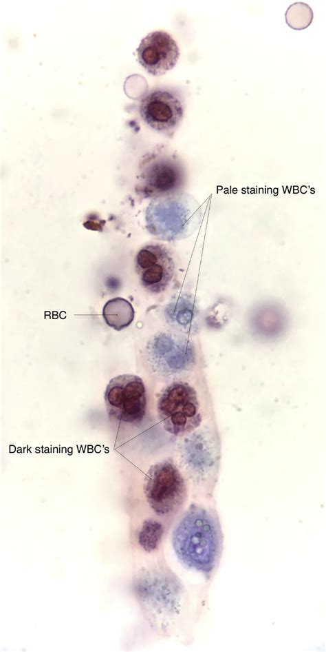 Stain Precipitate In Urine