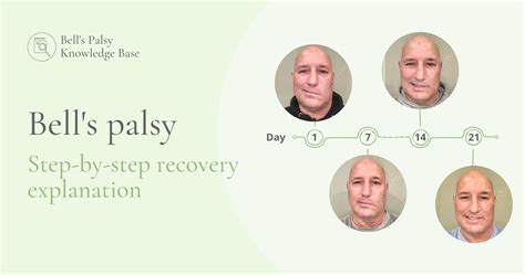 Step By Step Recovery Explanation Bell S Palsy Crystal Touch Bell S