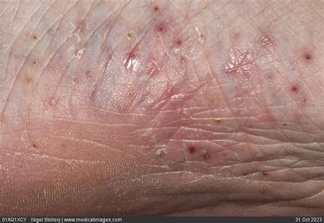 Stock Image Dermatology Plantar Pustular Psoriasis Multiple Red And
