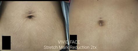 Stretch Marks Removal Miami 305 504 8942 Laser Treatment To Get Rid