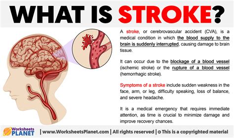 Stroke Definition Amp Medical Terminologies Lesson Study Com
