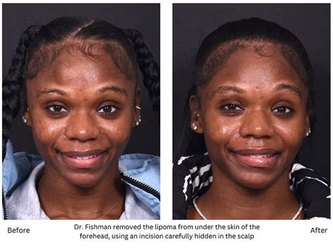 Successful Treatment Of Forehead Lipoma Depends On Knowledge Of The