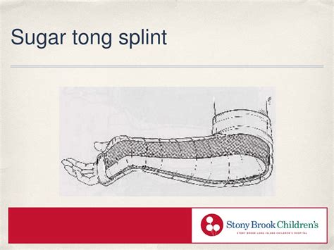 Sugar Tong Posterior Splint At Paul Harlan Blog