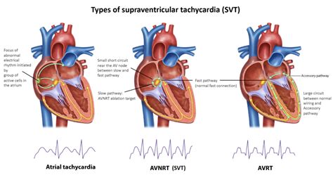 Supraventricular Tachycardia Medical Procedure