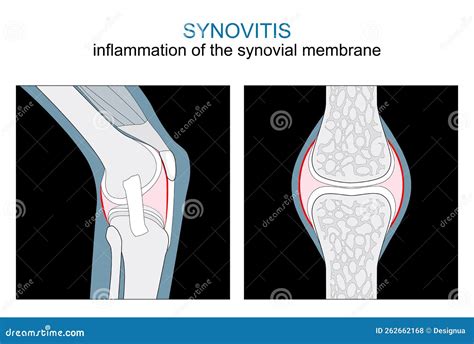 Synovitis Of The Knee Joint Inflammation Orthopedic Knee Specialist