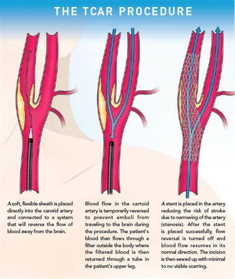 Tcar Medical Abbreviation