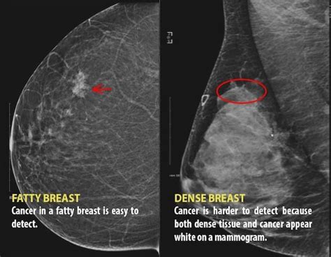 Telling Women They Have Dense Breasts Could Save Lives Says Cancer
