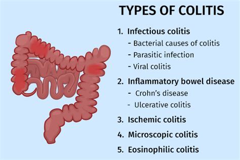 The Differences And Link Between Infectious Gastroenteritis And Colitis