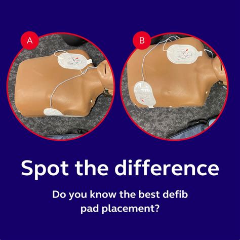 The Proper Placement Of Defib Pads A Quick Guide