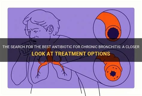 The Search For The Best Antibiotic For Chronic Bronchitis A Closer