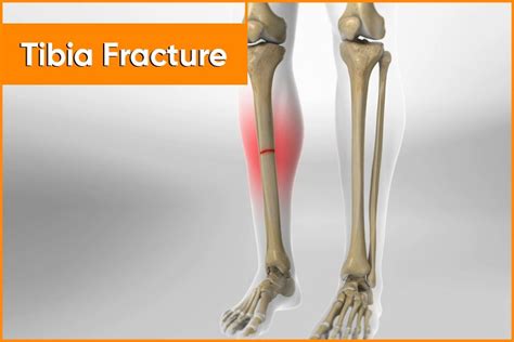 Tibia Fracture Symptoms Causes Treatment Rehabilitation