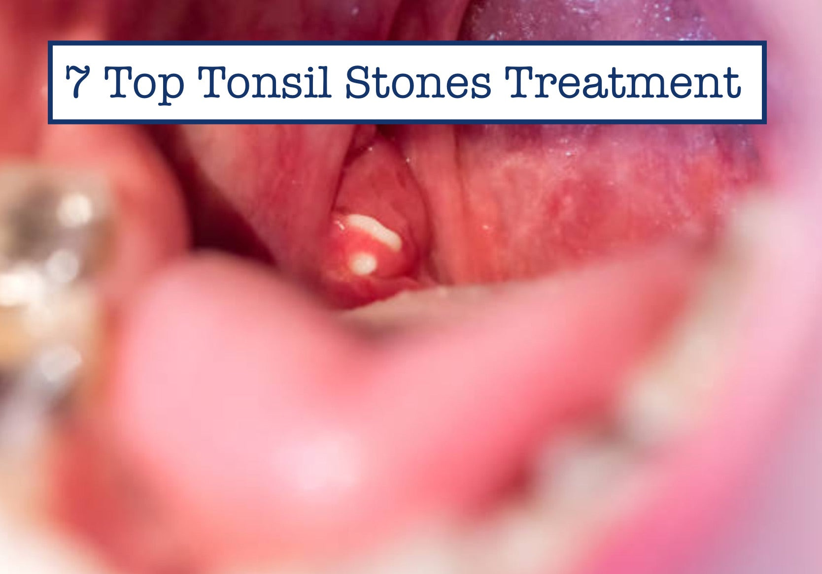 Tonsil Stones Pictures