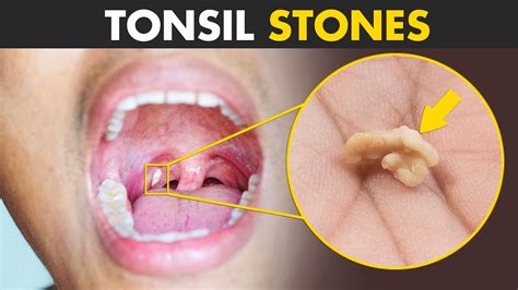 Tonsil Stones Up Close Tonsilloliths Youtube