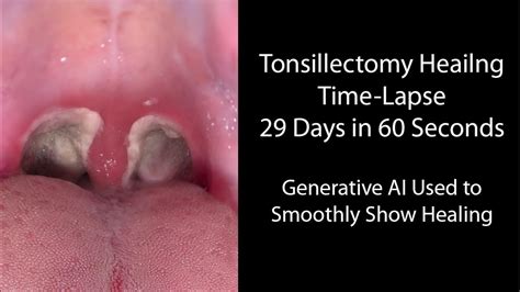 Tonsillectomy Recovery Photo Day 7 Tonsillectomy