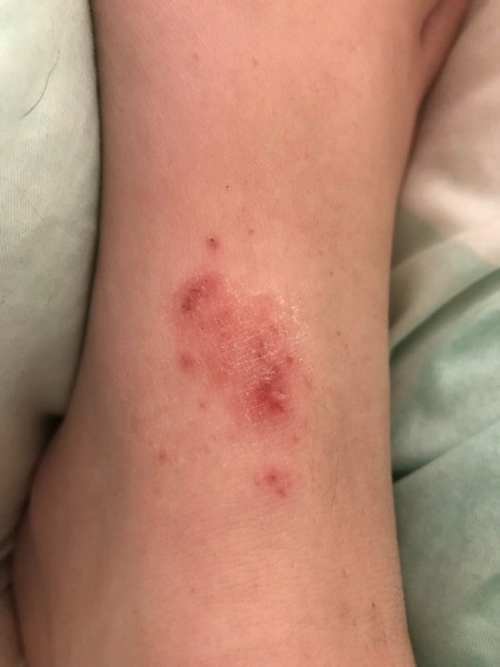 Treating A Rash On Feet Thriftyfun