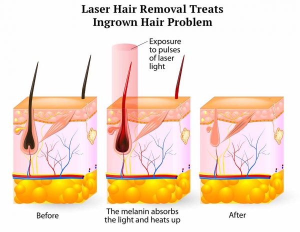 Treating And Preventing Ingrown Pubic Hair
