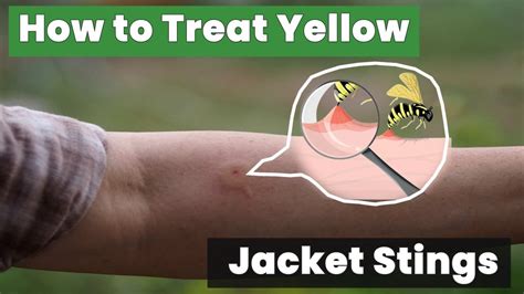 Treatment For A Yellow Jacket Sting Youtube