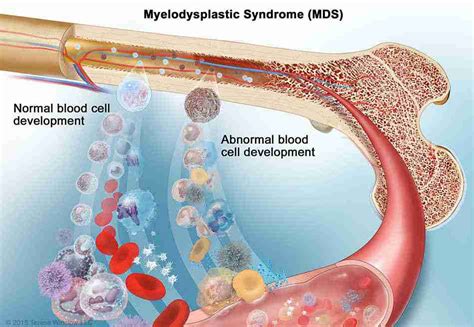 Treatment Of Myelodysplastic Syndromes
