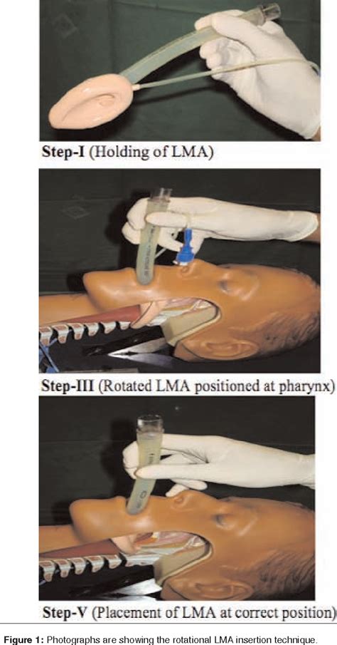 Tricks For Lma Insertion The Airway Jedi Technique Potential Problems