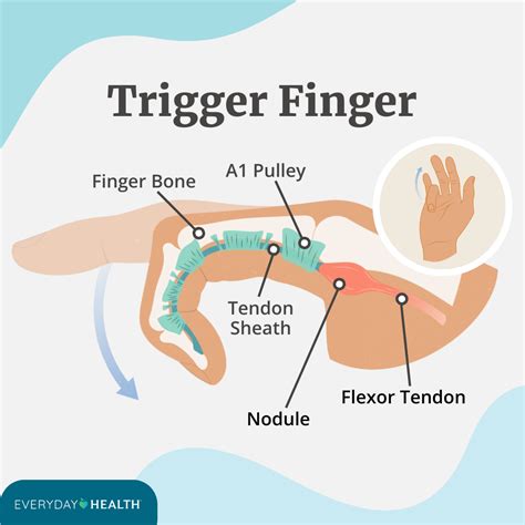 Trigger Finger Medical Procedure