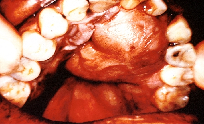 Trimethobenzamide Oral Wikidoc