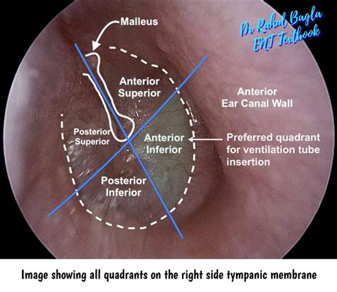 Tympanic Membrane Perforations Oto Surgery Atlas