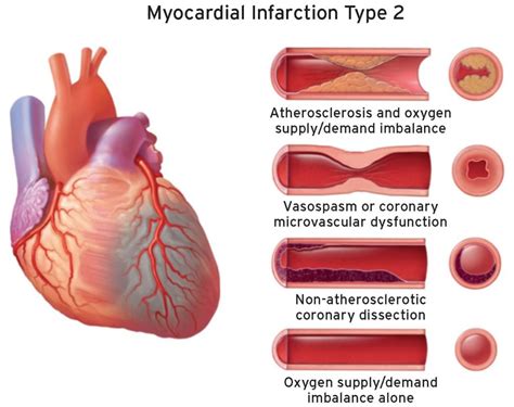 Type 2 Myocardial Infarction Diagnosis Prognosis And Treatment