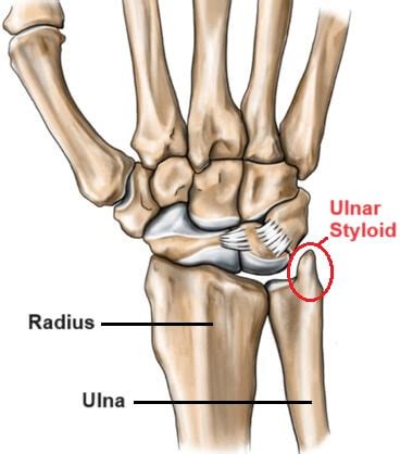 Ulnar Styloid Fracture