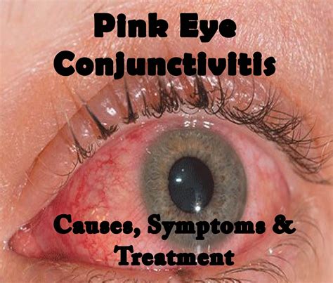Understanding Pink Eye Conjunctivitis Causes And Treatment