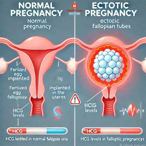 Understanding Tubal Pregnancy And Ectopic Hcg Levels Wehavekids