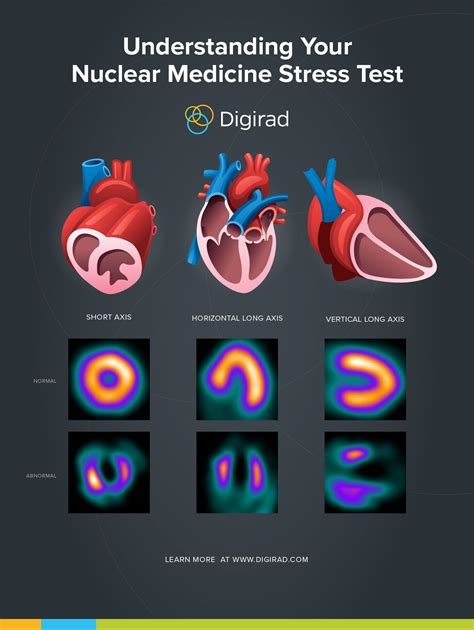 Understanding Your Nuclear Medicine Stress Test Digirad