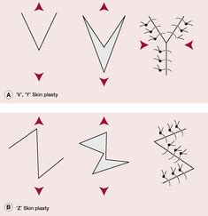 V Y Plasty Definition Of V Y Plasty By Medical Dictionary H C T P