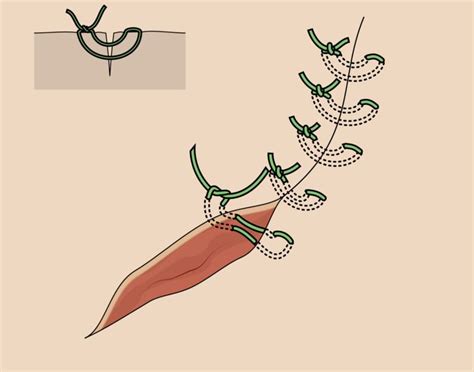 Vertical Mattress Stitch Alchetron The Free Social Encyclopedia