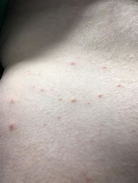 Weird Itchy Rash On Small Part Of Stomach Only R Dermatology