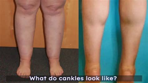 What Are Cankles