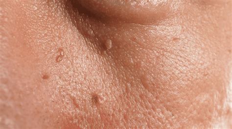 What Are Skin Tags Causes Of Skin Tags Schweiger Dermatology