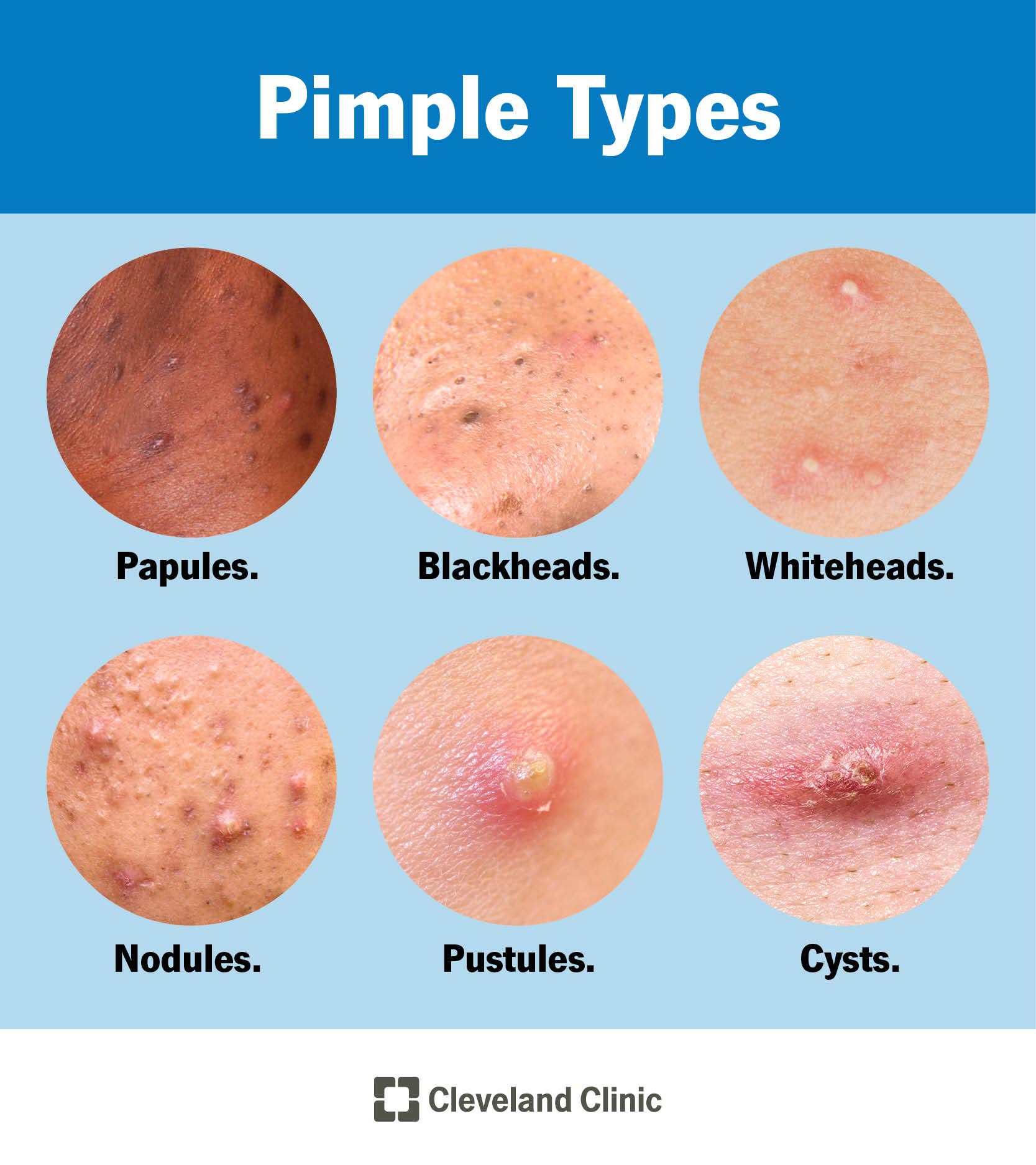 What Causes Pimples On Butt