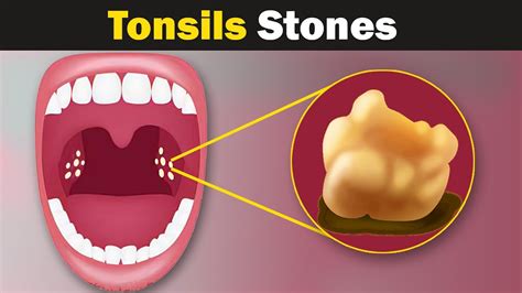 What Do Tonsil Stones Look Like In The Throat The 5 Variations