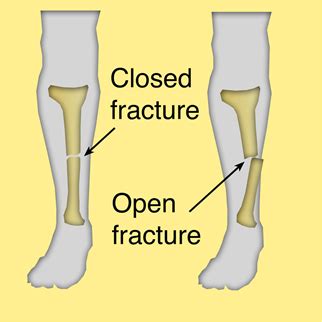 What Is A Closed Fracture